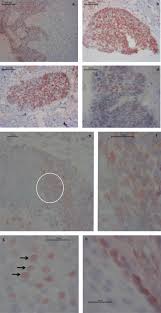 What do the results mean? Drh1 A Novel Blood Based Hpv Tumour Marker Ebiomedicine