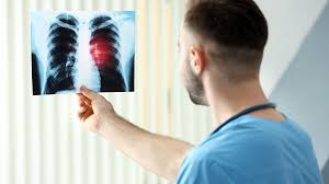 If lung cancer is found at an earlier stage, there is more chance of a better outcome. What Is Lung Cancer Awareness Month Walden University
