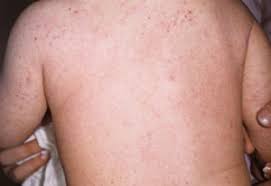 Eczema Dermatitis Symptoms And Treatment Essential Baby
