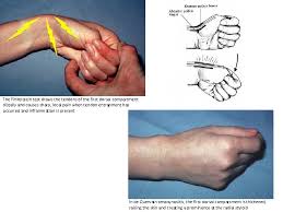 Finkelstein's test is a test used to diagnose de quervain's tenosynovitis in people who have wrist classical descriptions of the finkelstein's test are when the examiner grasps the thumb and ulnar. Kol Kaslari Devam M Articularis Cubiti M Anconeus