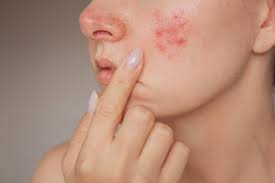 Image result for acne face