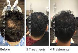 How can prp work for hair loss? Why Prp Hair Restoration Actually Works Pai Hair Restoration Mclean Virginia