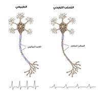 أبسط طرق العلاج لمرض التصلب اللويحي تناول أطعمة ذات طبيعة حارة و العناية بالأمور التالية: Ø§Ù„ØªØµÙ„Ø¨ Ø§Ù„Ù„ÙˆÙŠØ­ÙŠ Ø§Ø¹Ø±Ø§Ø¶ ÙˆØ¹Ù„Ø§Ø¬ Ø§Ù„ØªØµÙ„Ø¨ Ø§Ù„Ù„ÙˆÙŠØ­ÙŠ ÙˆÙŠØ¨ Ø·Ø¨