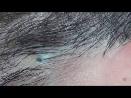 Blackheads 2019 72 Blackheads On Back And Shoulder Youtube Ingrown Hair Pimple Pimple Popping Ingrown Hair