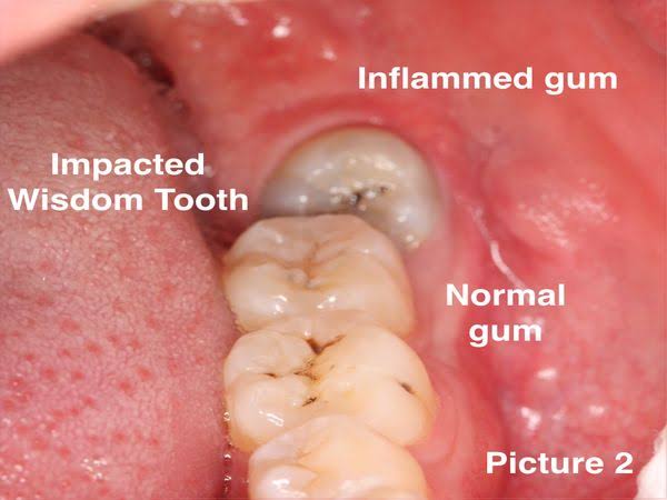 3RD MOLAR REMOVAL product image