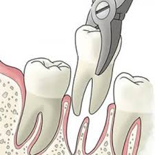 Typically, #toothextractions are a result of disease, injury trauma to your mouth, or overcrowding of your teeth. Tooth Extractions Midland Park Nj 201 447 5555