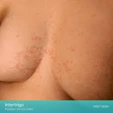 Image result for Intertrigo under breasts