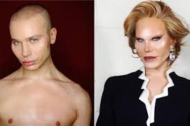 If you have a lung injury or illness, your doctor may tell you you need to have lung surgery as part of your treatment. Alexis Stone Convinced Followers He Got Botched Plastic Surgery Allure