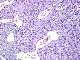 Image result for Glomus tumor