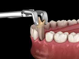 Image result for Tooth Extraction