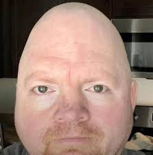 Are badgers okay to eat with TB?