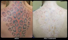 We offer breast augmentation, breast lift, breast reduction, abdominoplasty, liposuction location : Vanish Laser Tattoo Removal And Skin Aesthetics Datasphere
