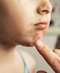 Viele kleinkinder fangen gern an, sich ausgiebig bewegen zu wollen, während sie darin sitzen. Herpes Bei Babys Kleine Blaschen Grosse Gefahr