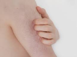 Image result for Keratosis pilaris