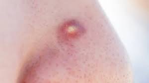 Image result for skin cancer on nose pimple