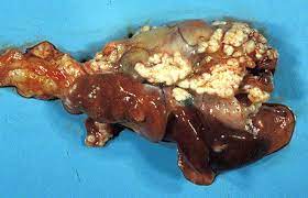 symptoms of pleural mesothelioma include a persistent dry or raspy cough, coughing up blood, and shortness of breath. Ten Cases Of Feline Mesothelioma An Immunohistochemical And Ultrastructural Study Sciencedirect
