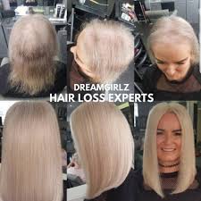 Best wigs for female pattern baldness. Hair Loss Dreamgirlz Hair Extensions