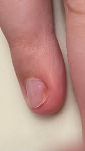 Image result for Pitting nails feet