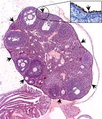 Yankeelov, then a cancer researcher at vanderbilt university , noticed that people's historically weak understanding of the weather bore surprising it becomes much easier to fight when we understand the mechanisms driving it — how a particular type of cancer is likely to grow in a particular person. Scientists Make Breakthroughs In Ovarian Cancer Research