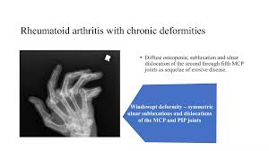 Image result for XRay Changes in Rheumatic Conditions