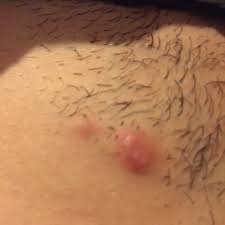 , i wish i had an ingrown hair, said no one, ever. I Have This Ingrown Hair For A Week Now It Dosnt Seem To Want To Pop Even With A Needle I Tried A Hot Warm Rag And It Didn T Do Anything But Numb