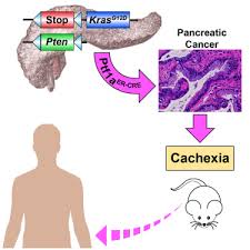Image result for Cachexia in Cancer
