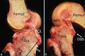 Image result for PCL Sulcus Test