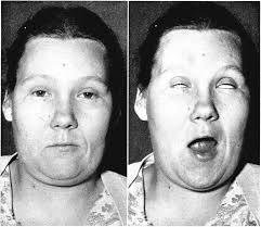 Inverse Jaw -W inking with Exaggerated Bell's Phenom enon By J. JANCAR  Jaw-winking (Marcus Gunn phenomenon) Marcus Gunn report