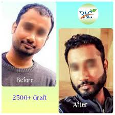 Indian Hair Transplant