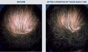 Each treatment is customised based on the respective individual's hair problems. Rogaine Malaysia Hair Loss Hair Regrowth Treatment