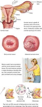 Being aware of any signs and symptoms of cervical cancer can also help avoid delays in diagnosis. Cervical Cancer Spectrum Health