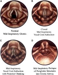 Image result for Vocal Cord Dysfunction