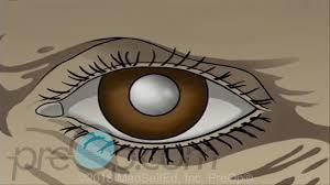 Cataract Small Incision Surgery Preop Patient Education And Engagement Youtube