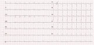 Start studying miocarditis y enfermedades del pericardio. Myocarditis In Adult Onset Still S Disease Case Based Review Springerlink