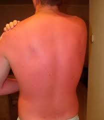 Sunburn causes a range of problems like pain, premature ageing, precancerous lesions, and skin cancer. Anatomy Of A Sunburn A Timeline Of Dermatological Destruction