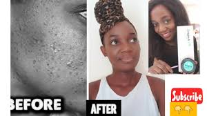 Longrich bamboo charcoal soap side effects. Violahb What Longrich Soap And Cream Did To My Face Youtube