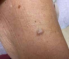 Image result for Nodule
