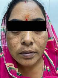 Graves' Disease: A Review