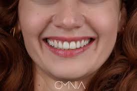 Şeffaf Plak Tedavisi, Invisalign Tedavisi İzmir