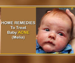 Here are some home remedies to treat baby acne...👇