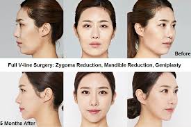 Everything you need to know about plastic surgery procedures in korea. 53 Most Popular Plastic Surgery Procedures In Korea Seoul Guide Medical