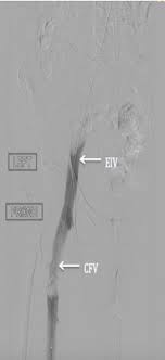Cureus May Thurner Syndrome A Rare Cause Of Deep Venous Thrombosis