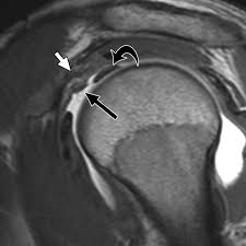 Image result for Shoulder MRI