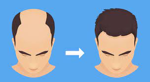 Ishrs steht für internationale gesellschaft für haarchirurgie und ist eine organisation, die die qualität von. Haartransplantation Empfehlung Und Tipps Gegen Haarausfall