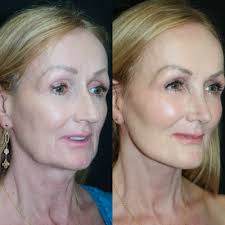 John G. Westine, MD, Board Certified Facial Plastic Surgeon