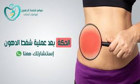الهدف من علاج شفط الدهون من البطن هو تغيير شكل الجسم وإزالة الدهون غير المرغوب فيها. Ø§Ù„Ø­ÙƒØ© Ø¨Ø¹Ø¯ Ø¹Ù…Ù„ÙŠØ© Ø´ÙØ· Ø§Ù„Ø¯Ù‡ÙˆÙ† Ù…Ø§ Ù‡ÙŠ Ø£Ø³Ø¨Ø§Ø¨Ù‡Ø§ ÙˆØ£ÙØ¶Ù„ 7 Ø·Ø±Ù‚ Ù„Ø¹Ù„Ø§Ø¬Ù‡Ø§ In 2021 Uji