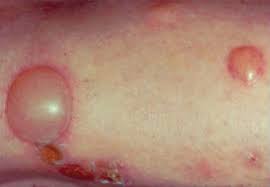Image result for Papular urticaria
