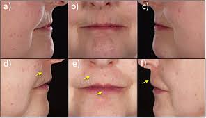 Stem cell-enriched lipotransfer improves facial fibrosis in systemic  sclerosis