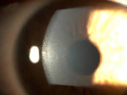 A Curious Fact Photic Sneeze Reflex Autosomical Dominant Compelling Helio Ophthalmic Outburst Syndrome Sciencedirect