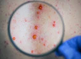 We did not find results for: Syphilis Une Infection Qui Simule De Nombreuses Maladies Pourquoi Docteur